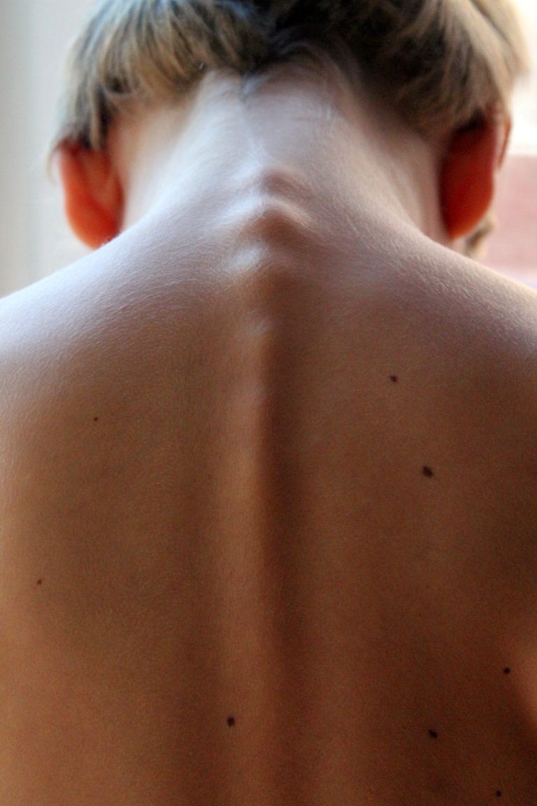Ayurvedic Spinal Cord Treatment in Palakkad
